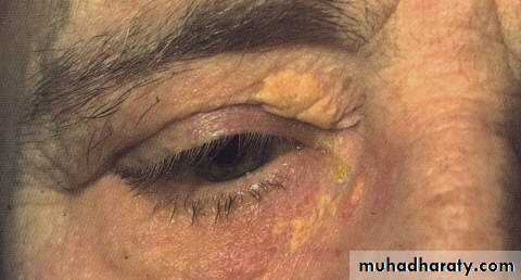 eye lid