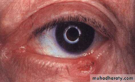 eye lid