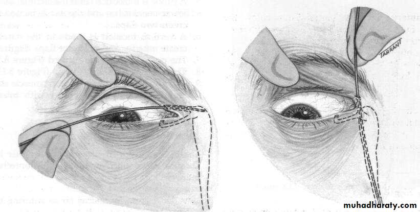 eye lid
