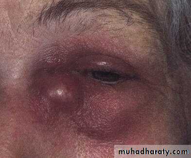 eye lid