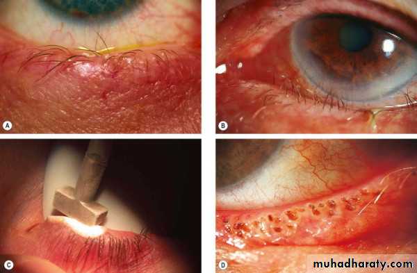 eye lid