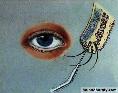 eye lid