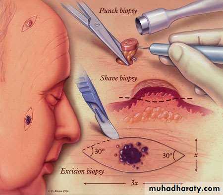 oral cancer