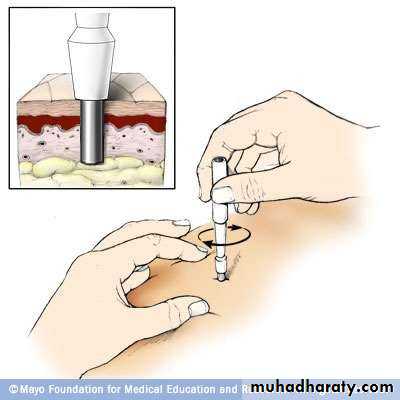 oral cancer