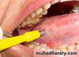 oral cancer