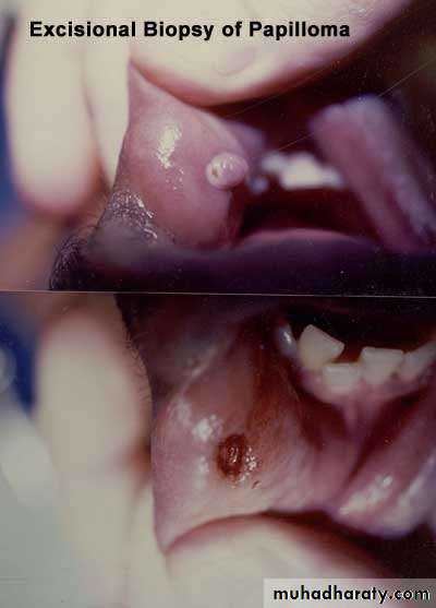 oral cancer