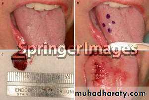 oral cancer