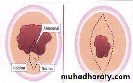 oral cancer