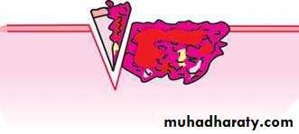 oral cancer