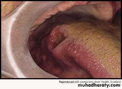 oral cancer