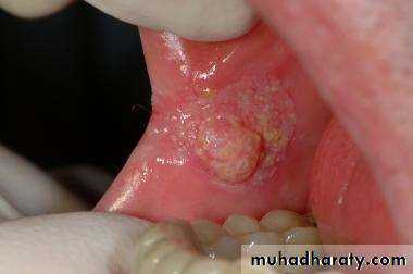 oral cancer