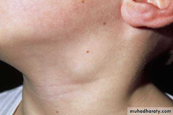 oral cancer