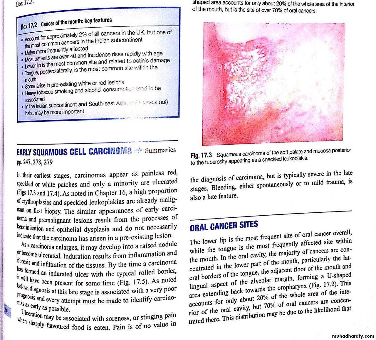 oral cancer
