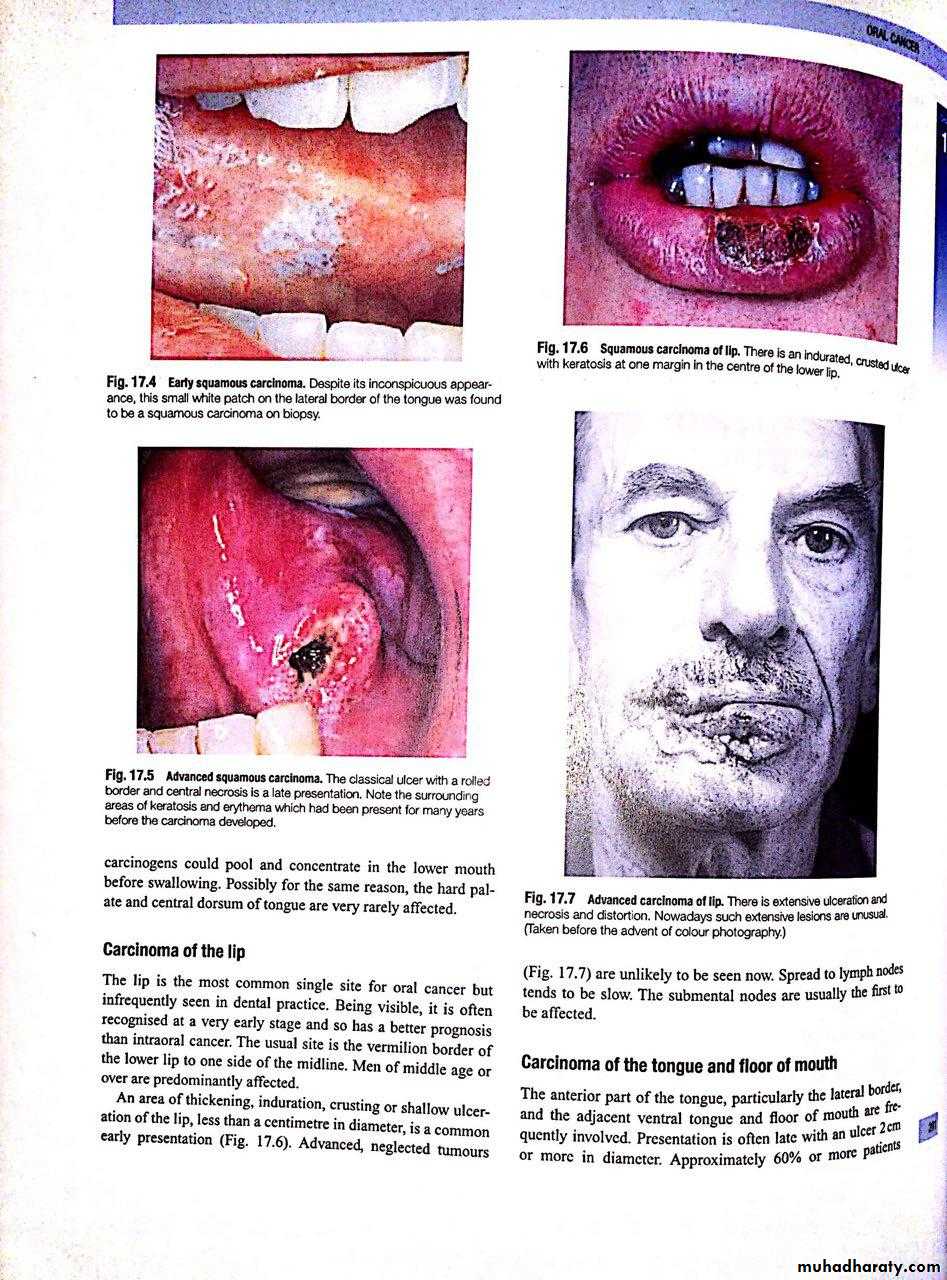 oral cancer