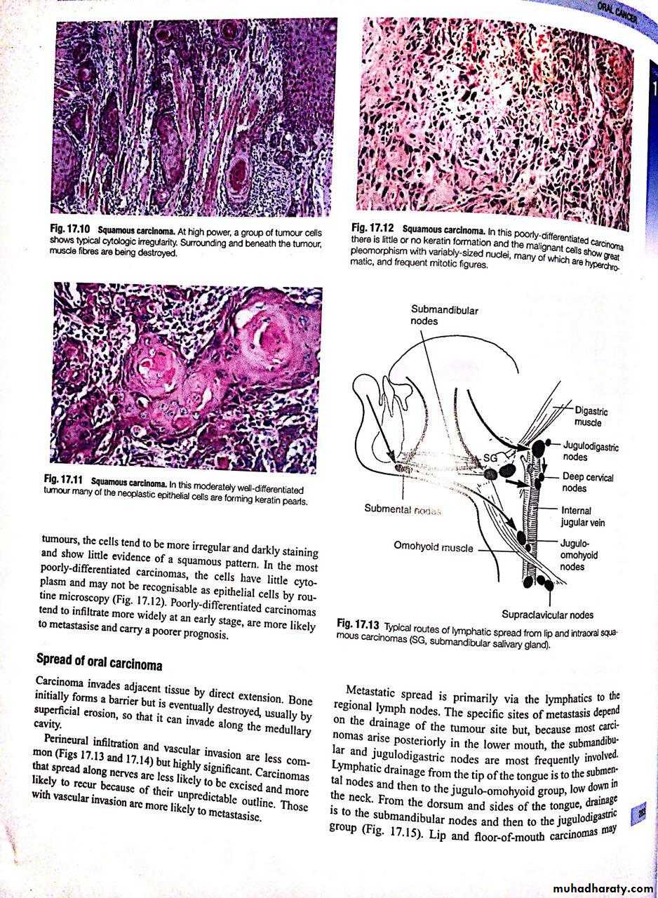 oral cancer