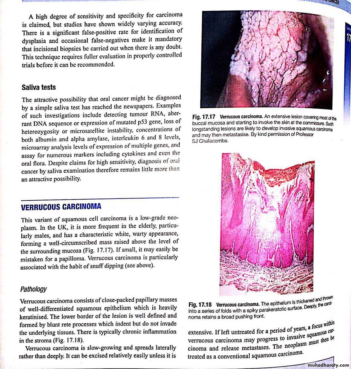 oral cancer
