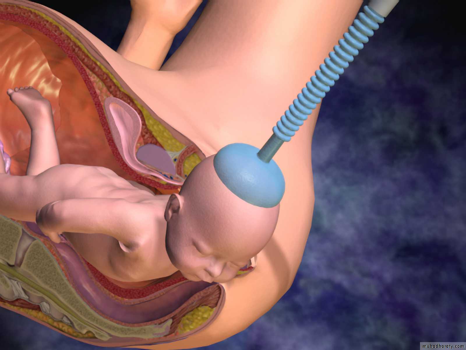 obstetric procedures