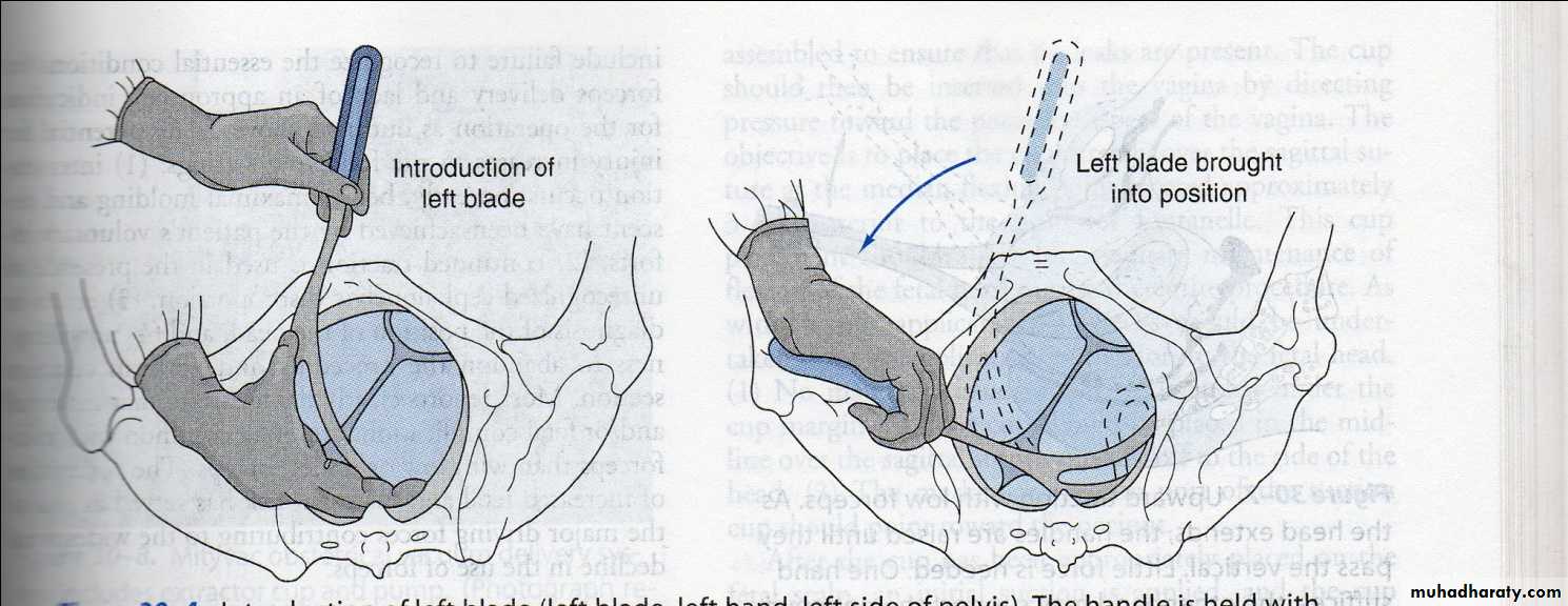 obstetric procedures