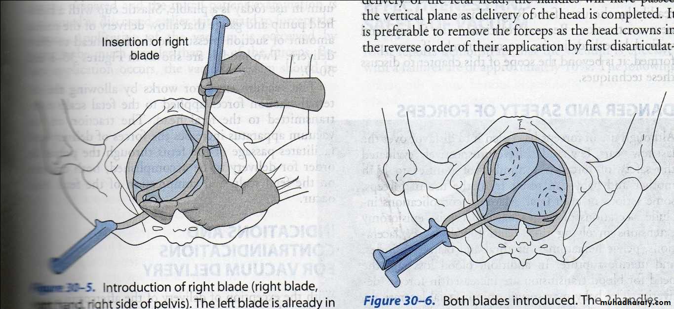 obstetric procedures