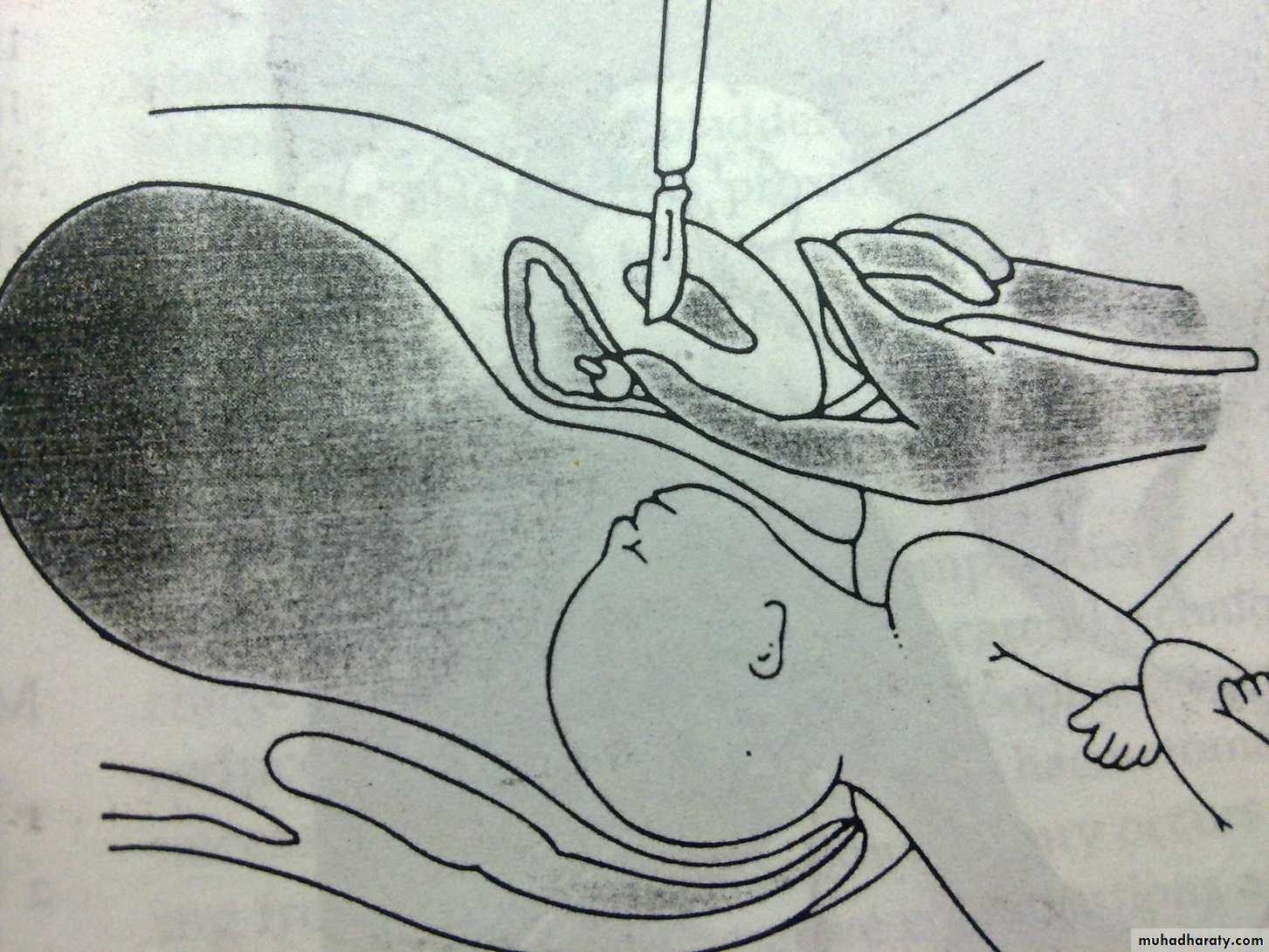 obstetric procedures