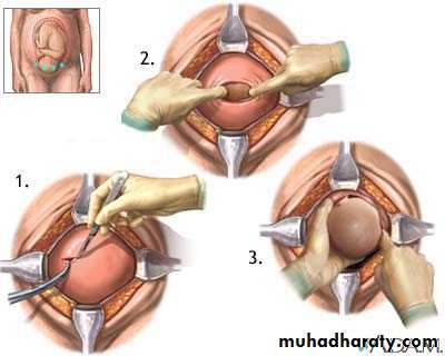 obstetric procedures