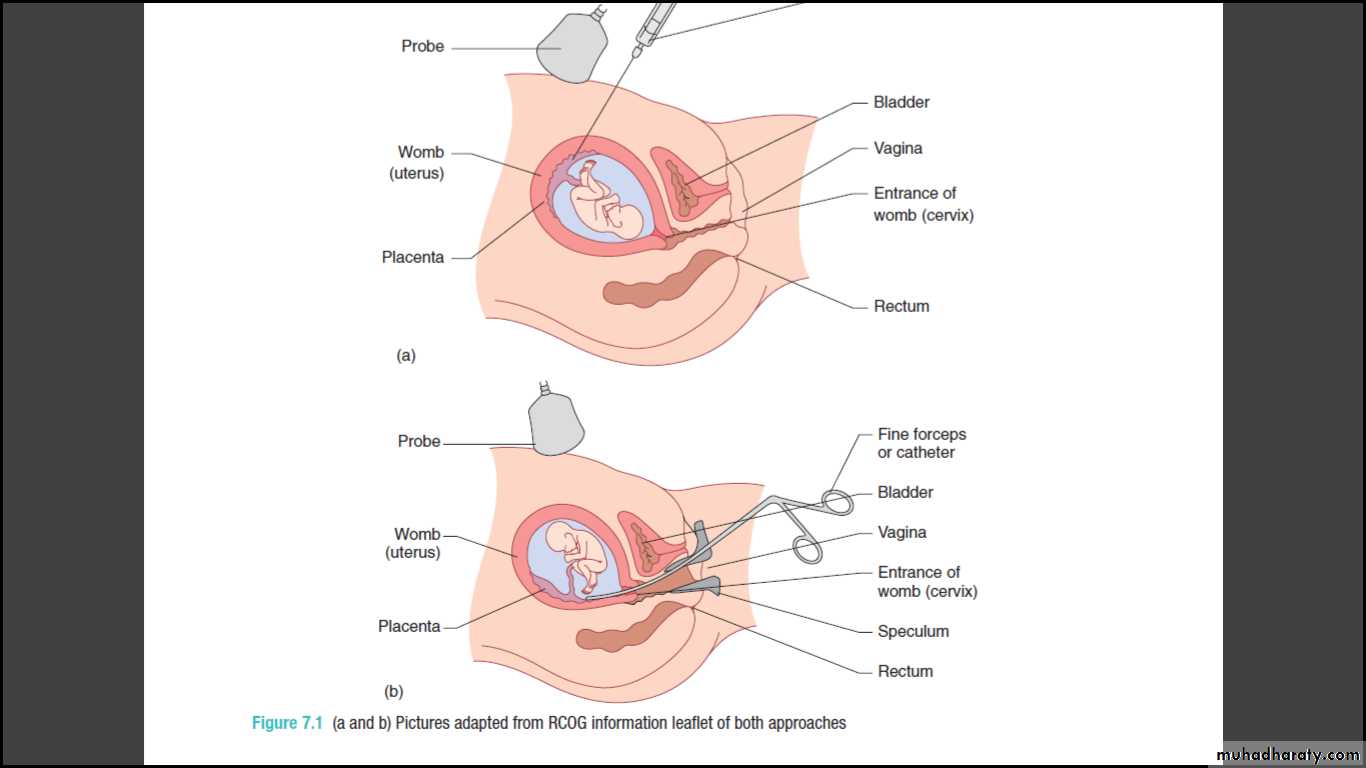 prenatal test