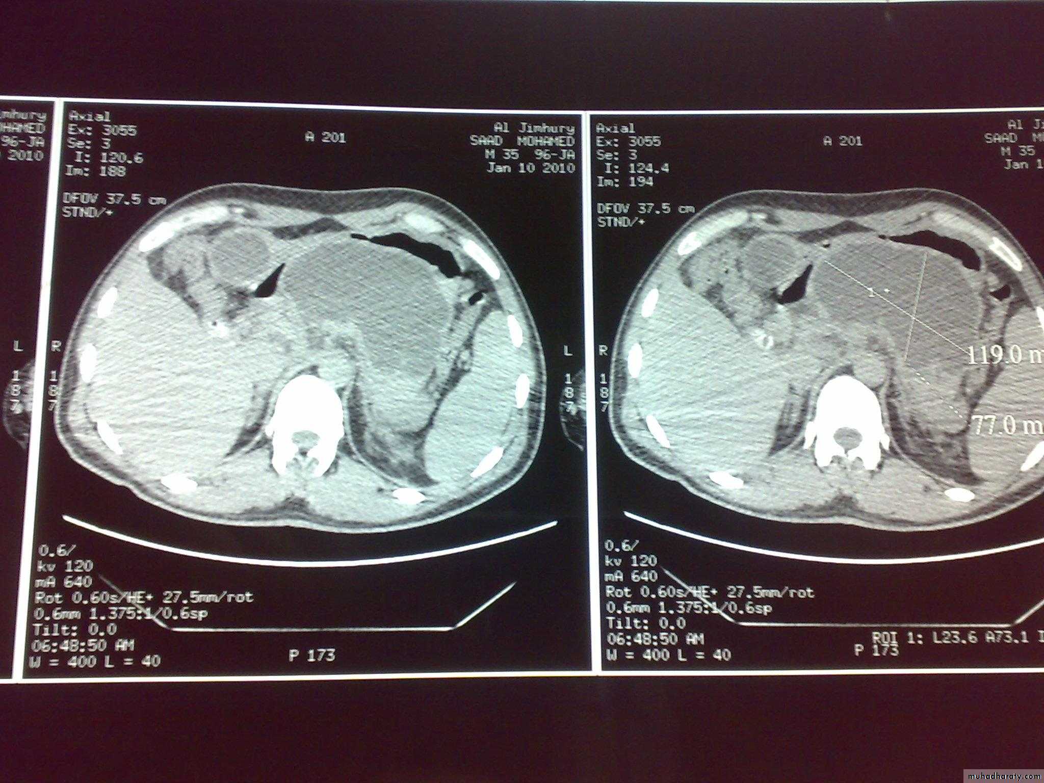 the pancreas