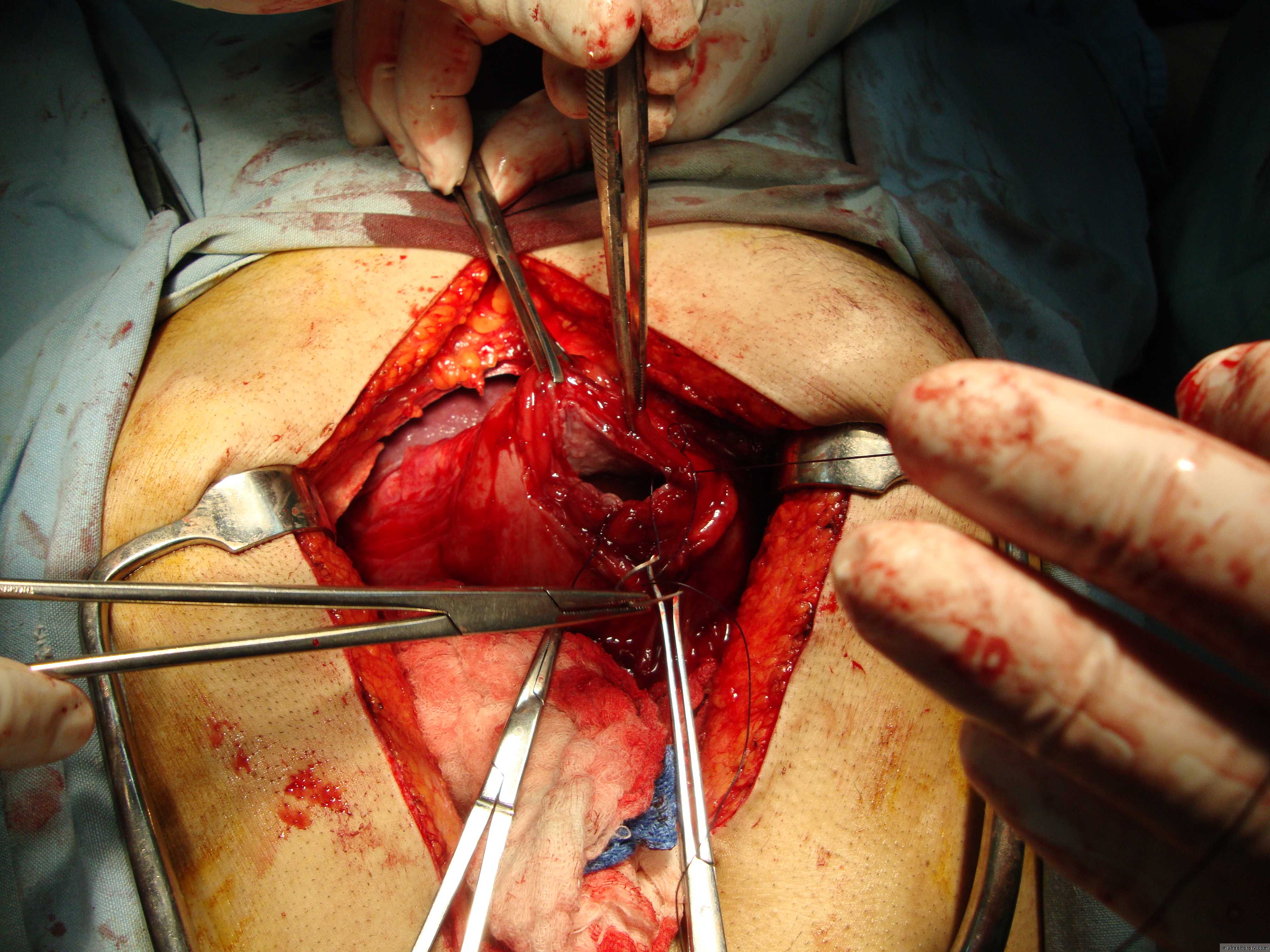 the pancreas