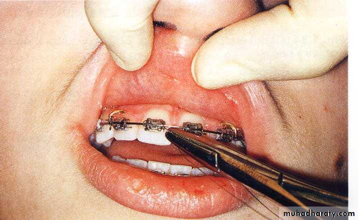 fixed appliance