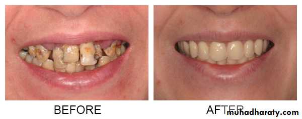 Immediate Denture