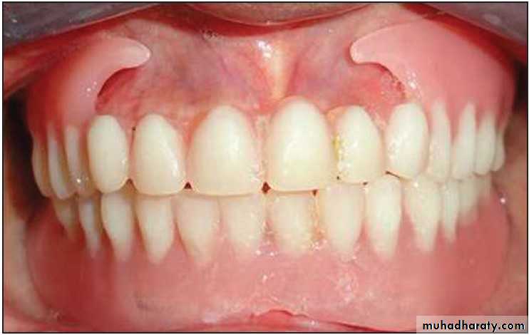 Immediate Denture
