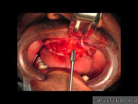 Immediate Denture