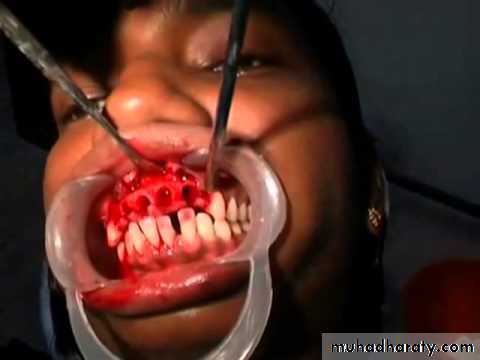 Immediate Denture