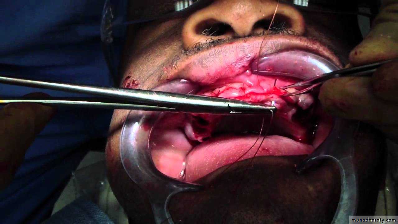 Immediate Denture