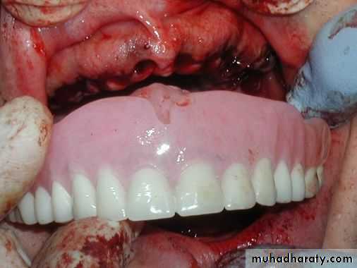 Immediate Denture