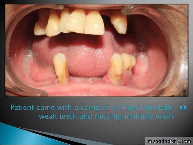 Immediate Denture