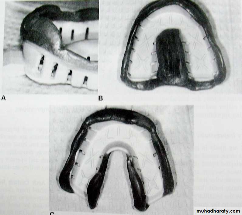 Immediate Denture
