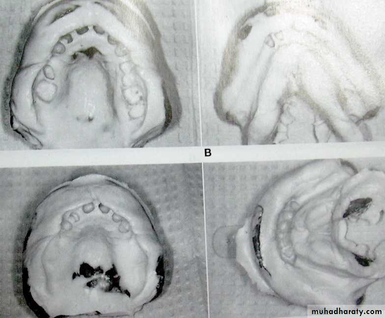 Immediate Denture