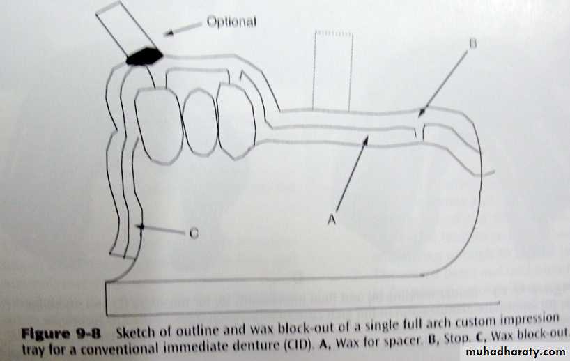 Immediate Denture