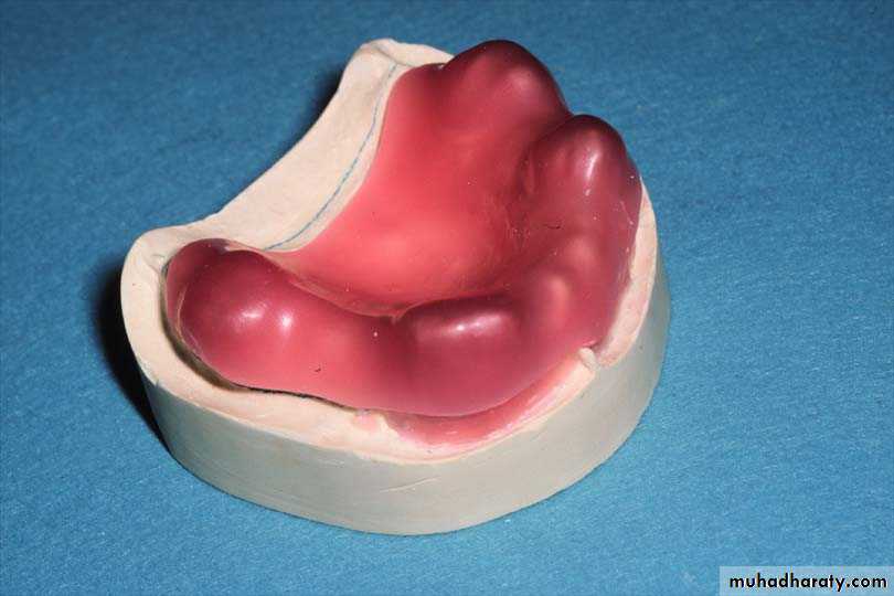 Immediate Denture