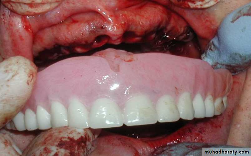 Immediate Denture