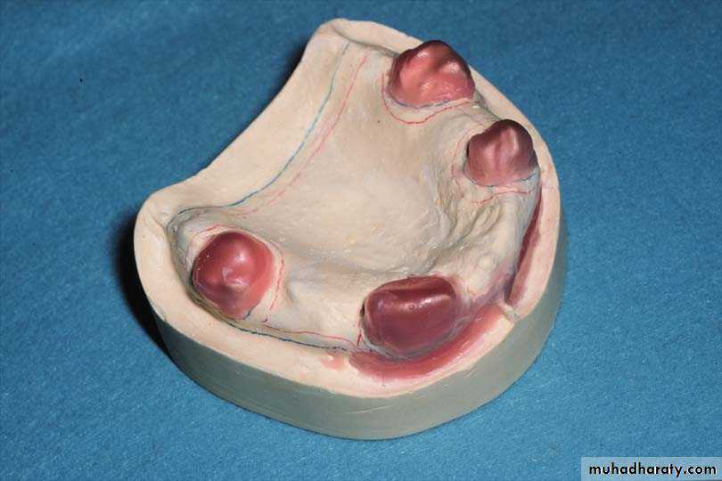Immediate Denture