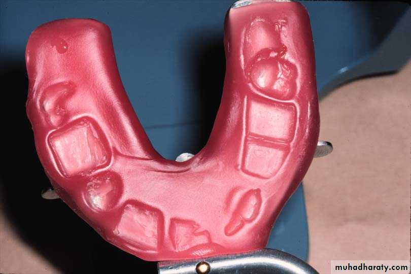 Immediate Denture