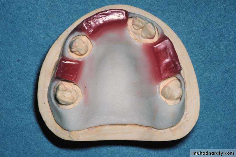 Immediate Denture