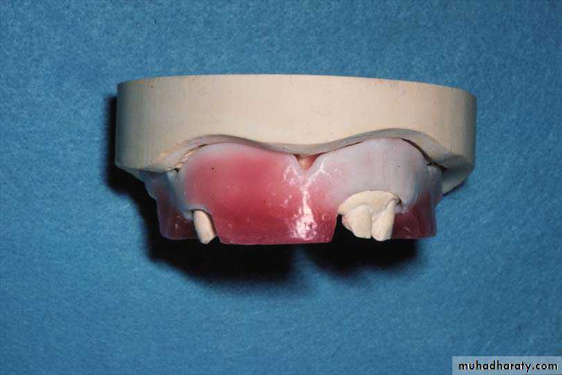 Immediate Denture