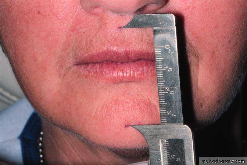 Immediate Denture