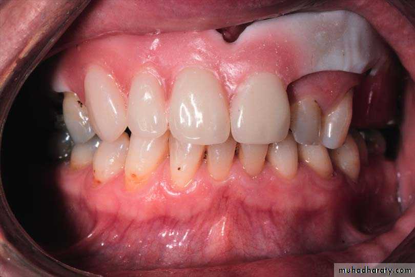 Immediate Denture