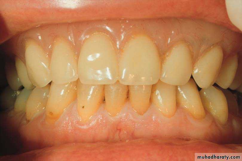 Immediate Denture