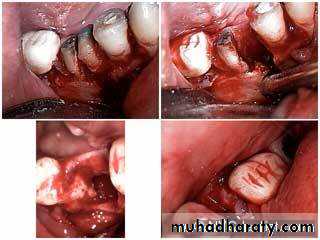 Immediate Denture