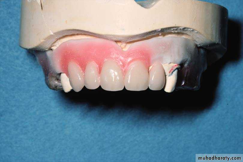 Immediate Denture